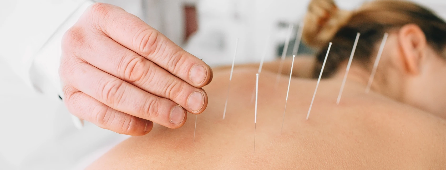 Acupuncture